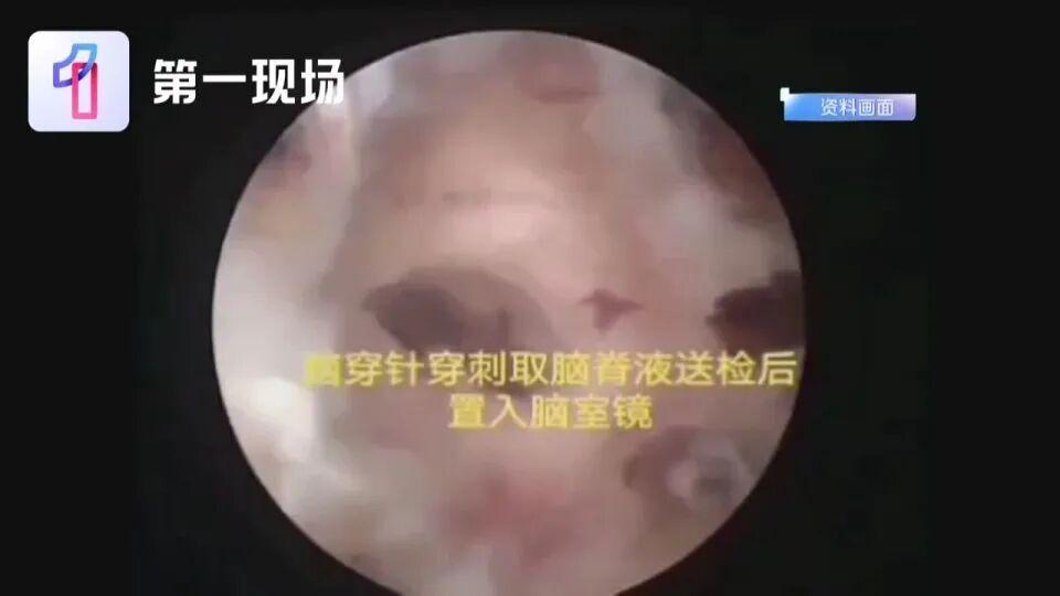  【深度复盘】李斯特菌感染致死率达20%：从深圳23岁女孩病例看“冰箱杀手”的致命机制与防控指南 健康养生